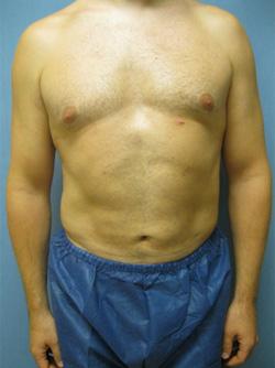 After Results for Liposuction