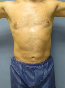 After Results for Liposuction