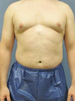 Before Results for Liposuction