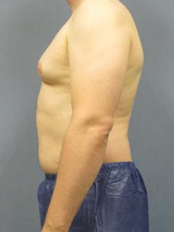 Before Results for Liposuction