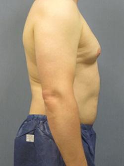 Before Results for Liposuction