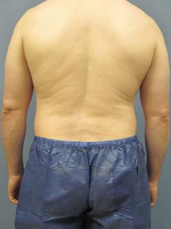 Before Results for Liposuction