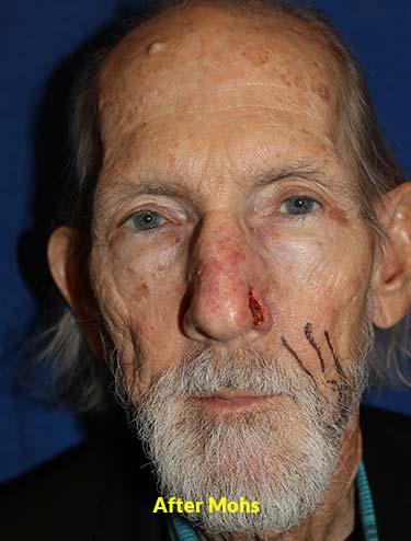 After Results for Skin Cancer