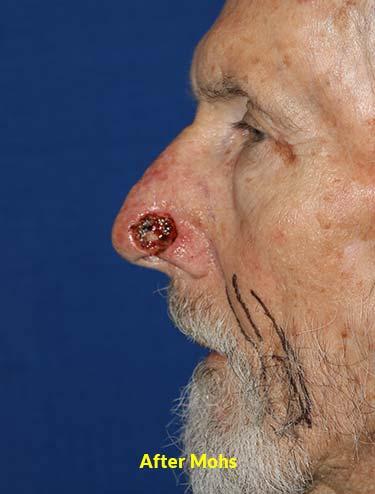 After Results for Skin Cancer