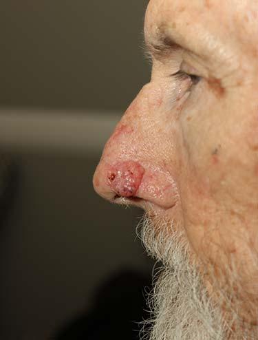 Before Results for Skin Cancer