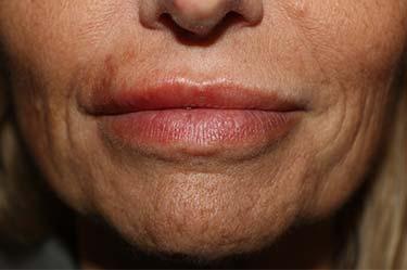 After Results for Neuromodulators (Botox / Dysport), Tissue Fillers, Lip Augmentation