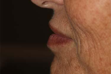 After Results for Neuromodulators (Botox / Dysport), Tissue Fillers, Lip Augmentation
