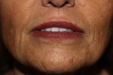Before Results for Neuromodulators (Botox / Dysport), Tissue Fillers, Lip Augmentation