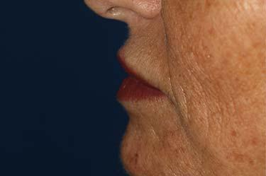 Before Results for Neuromodulators (Botox / Dysport), Tissue Fillers, Lip Augmentation