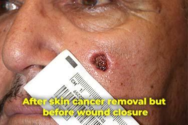 After Results for Skin Cancer
