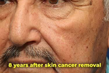 After Results for Skin Cancer