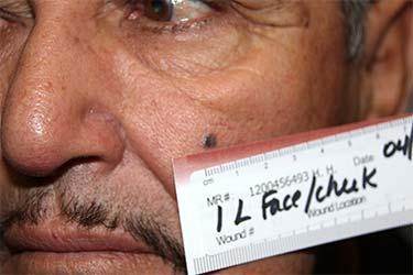 Before Results for Skin Cancer