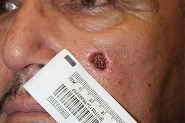 Before Results for Skin Cancer