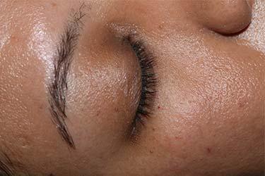 After Results for Skin Cancer