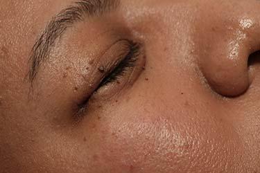 Before Results for Skin Cancer