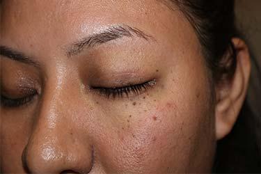 Before Results for Skin Cancer