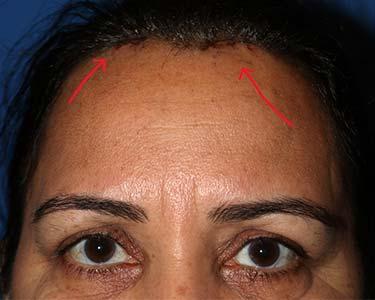 After Results for Skin Cancer