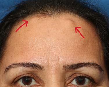 Before Results for Skin Cancer