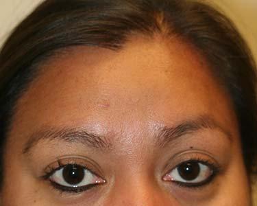 After Results for Skin Cancer