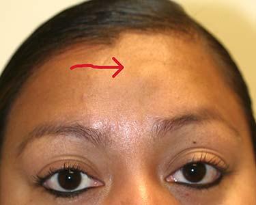 Before Results for Skin Cancer