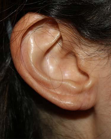 After Results for Otoplasty