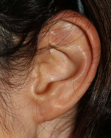 After Results for Otoplasty