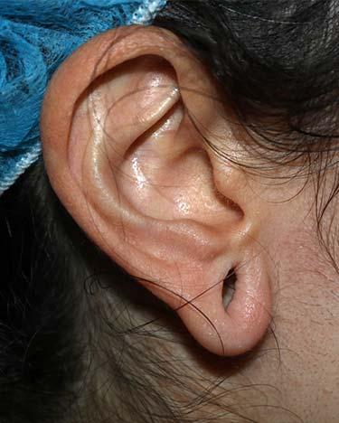 Before Results for Otoplasty