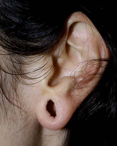 Before Results for Otoplasty