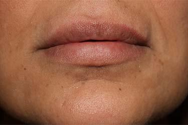 After Results for Tissue Fillers, Lip Augmentation