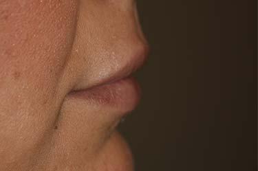 After Results for Tissue Fillers, Lip Augmentation