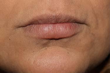 Before Results for Tissue Fillers, Lip Augmentation