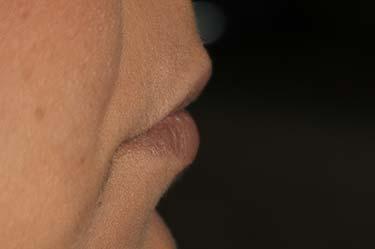Before Results for Tissue Fillers, Lip Augmentation