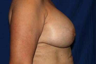 After Results for Implant Exchange and Removal
