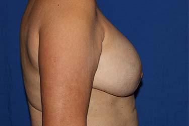 Before Results for Implant Exchange and Removal