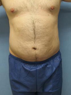 After Results for Liposuction