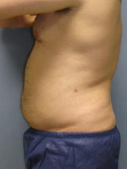 After Results for Liposuction