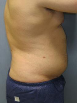 After Results for Liposuction