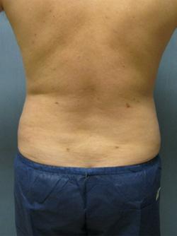 After Results for Liposuction