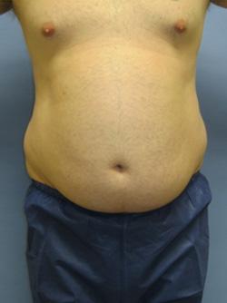 Before Results for Liposuction