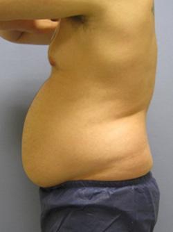 Before Results for Liposuction