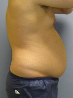 Before Results for Liposuction