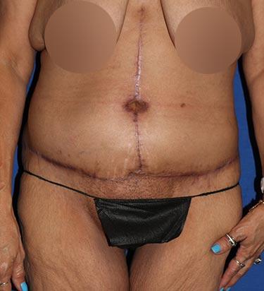 After Results for Tummy Tuck