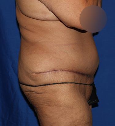 After Results for Tummy Tuck