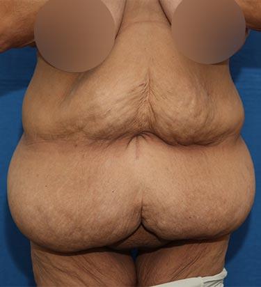 Before Results for Tummy Tuck