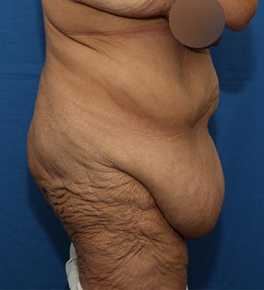 Before Results for Tummy Tuck