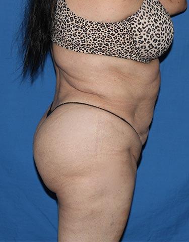 After Results for Brazilian Butt Lift / Gluteal Augmentation