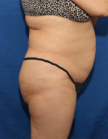 Before Results for Brazilian Butt Lift / Gluteal Augmentation