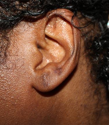 After Results for Otoplasty