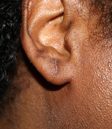After Results for Otoplasty