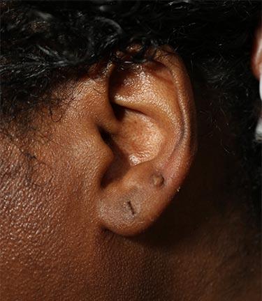 Before Results for Otoplasty
